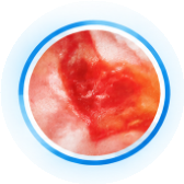 Thermal & Chemical Burns