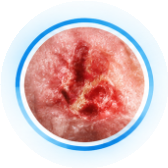 Diabetic Foot Ulcers