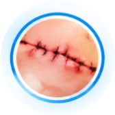 Surgical Wounds & Dehiscence