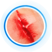 Cuts & Acute Abrasions