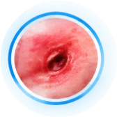 Pressure Sores & Decubitus Ulcers