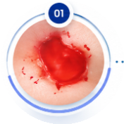 Bleeding Phase