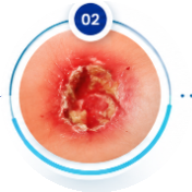 Swelling & Inflammation Phase