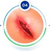 Wound Contraction Phase